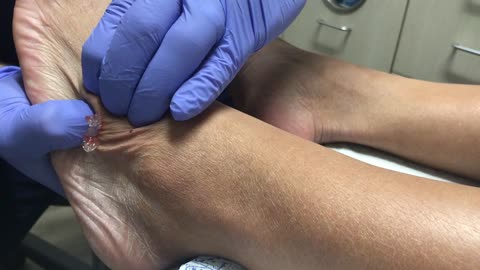 Ganglion Cyst Pop_ “It’s like Jelly”