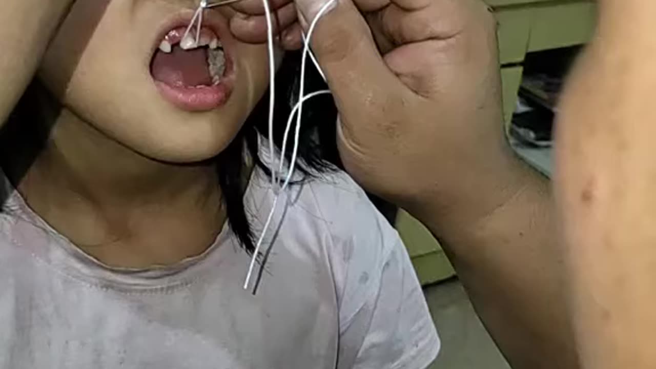 Teeth pulling out