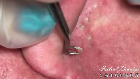 Deep Blackheads Removal from Cheeks and Nose Best Pimple Popping Videos