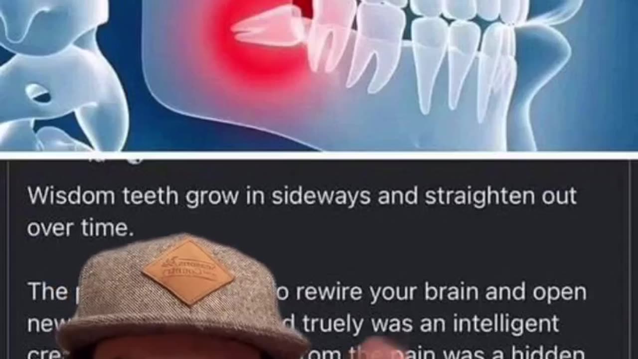 THE REAL REASON WHY WISDOM TEETH GET REMOVED