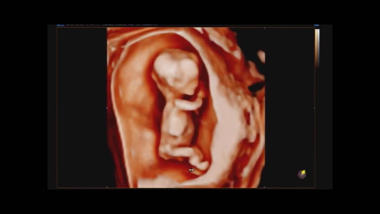 an ultrasound image of a fetus