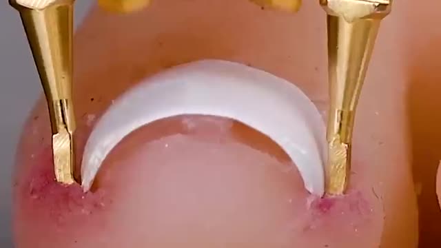 Ingrown toenail gadget hack