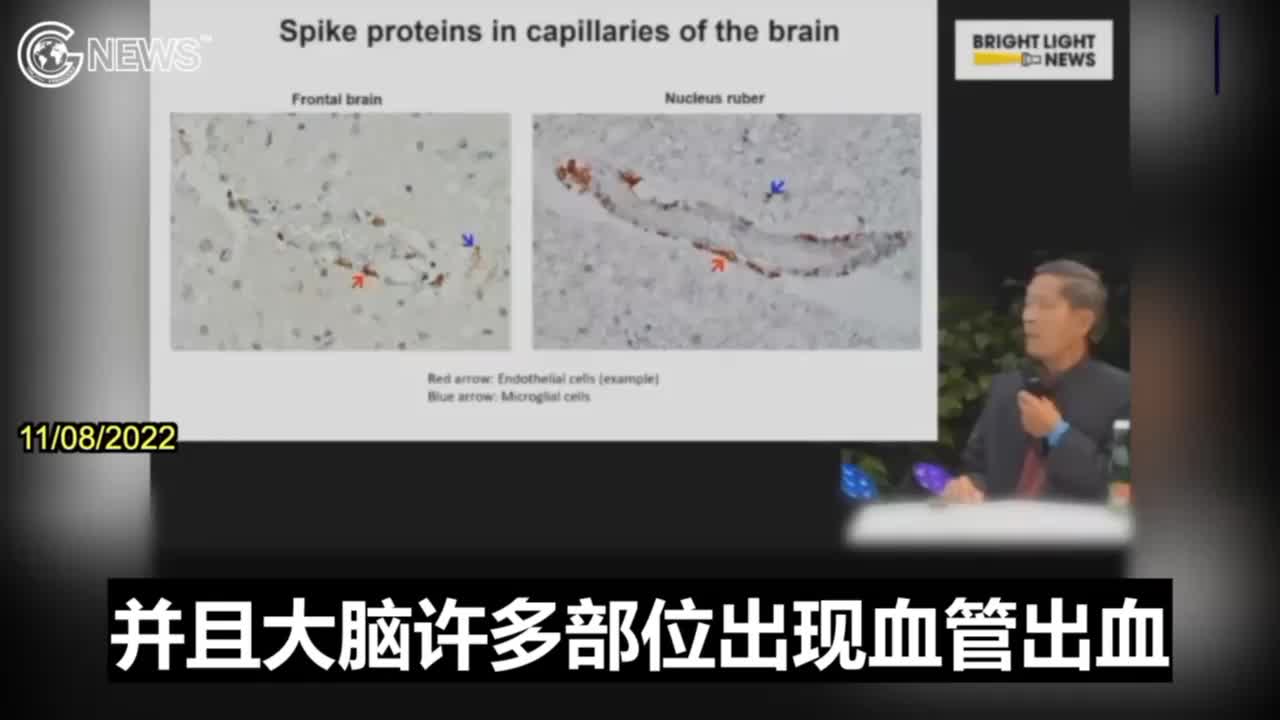 11/08/2022 WION新聞台報導：德國🇩🇪的蘇查瑞•巴克迪教授闡述極為罕見的腦梗塞驗屍案例，驗屍結果：死者感染的病毒並沒有細胞核，所以致因為疫苗所產生的