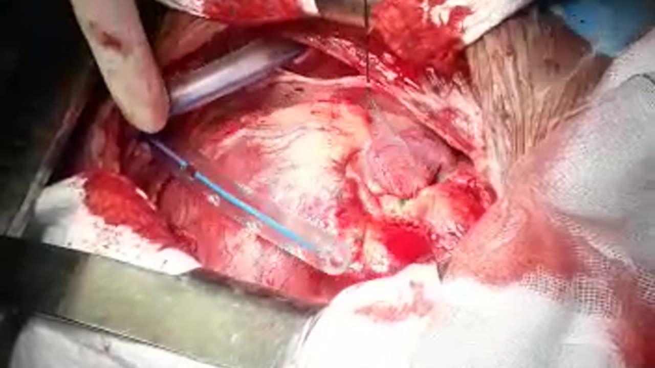 Open Heart surgery