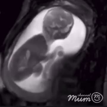 Mother's Day; Babies are alive before being aborted