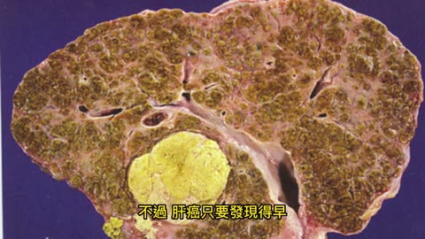 阿嬤喝果菜汁半年 3.5公分腫瘤消失了