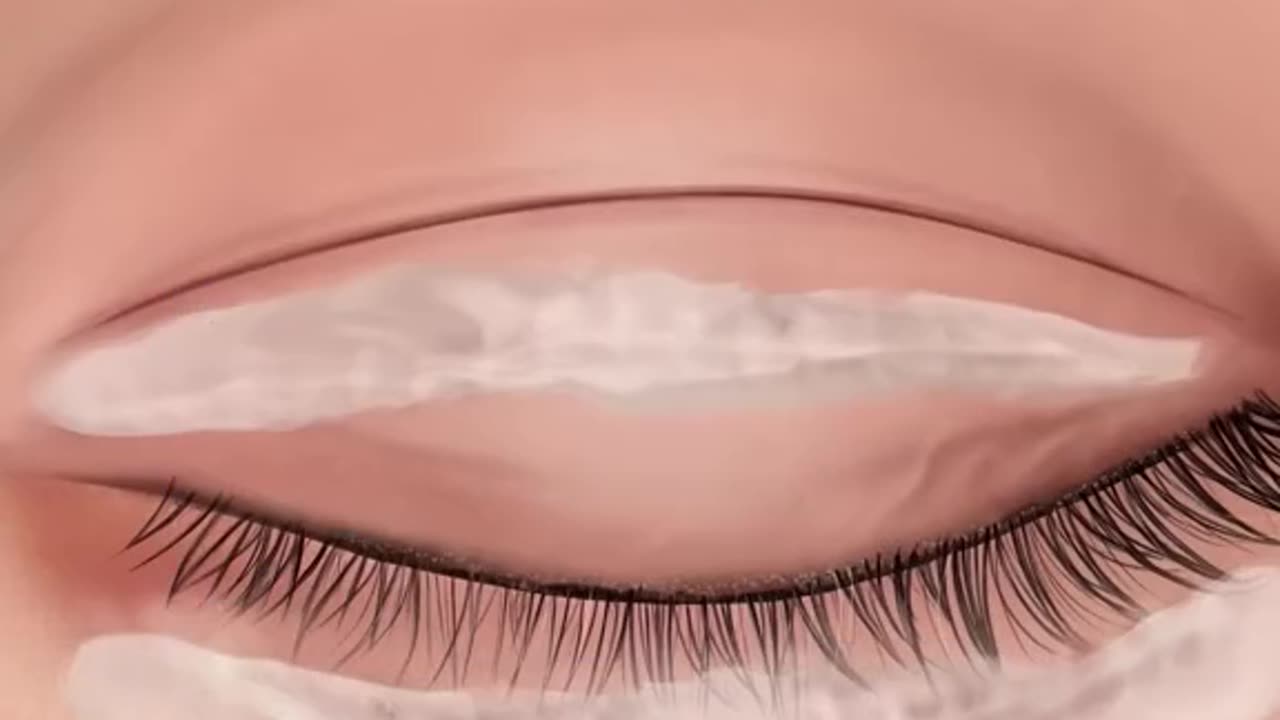 Asmr surgery