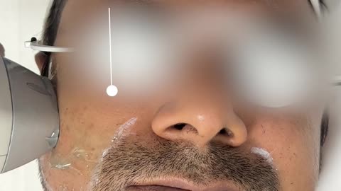 Laser Beard Shaping | La Midas Aesthetics