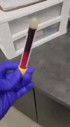 3 minutes after blood from vaxxed drawn it clots. This in NOT normal!