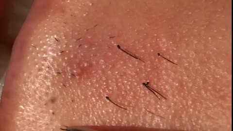 Super Satisfying Ingrown Hair Removal Ingrown Hair Removal 2022 Compilation3 #shorts