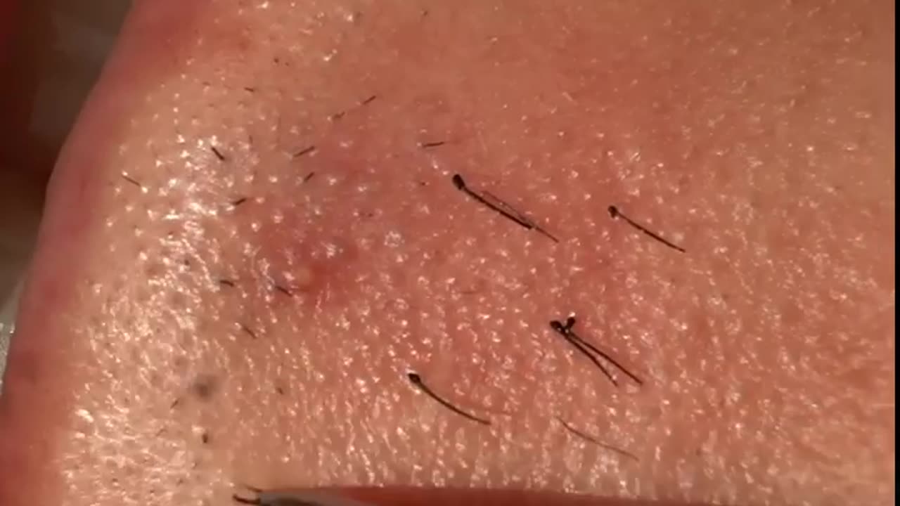 Super Satisfying Ingrown Hair Removal Ingrown Hair Removal 2022 Compilation3 #shorts