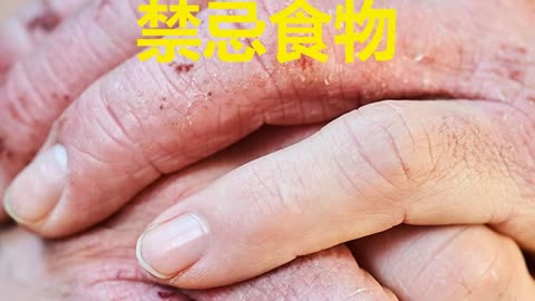 汗皰疹(dyshidrotic eczema) 禁忌食物