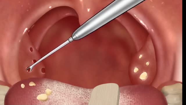 Cause of bad breath! Tonsil stone removal animation