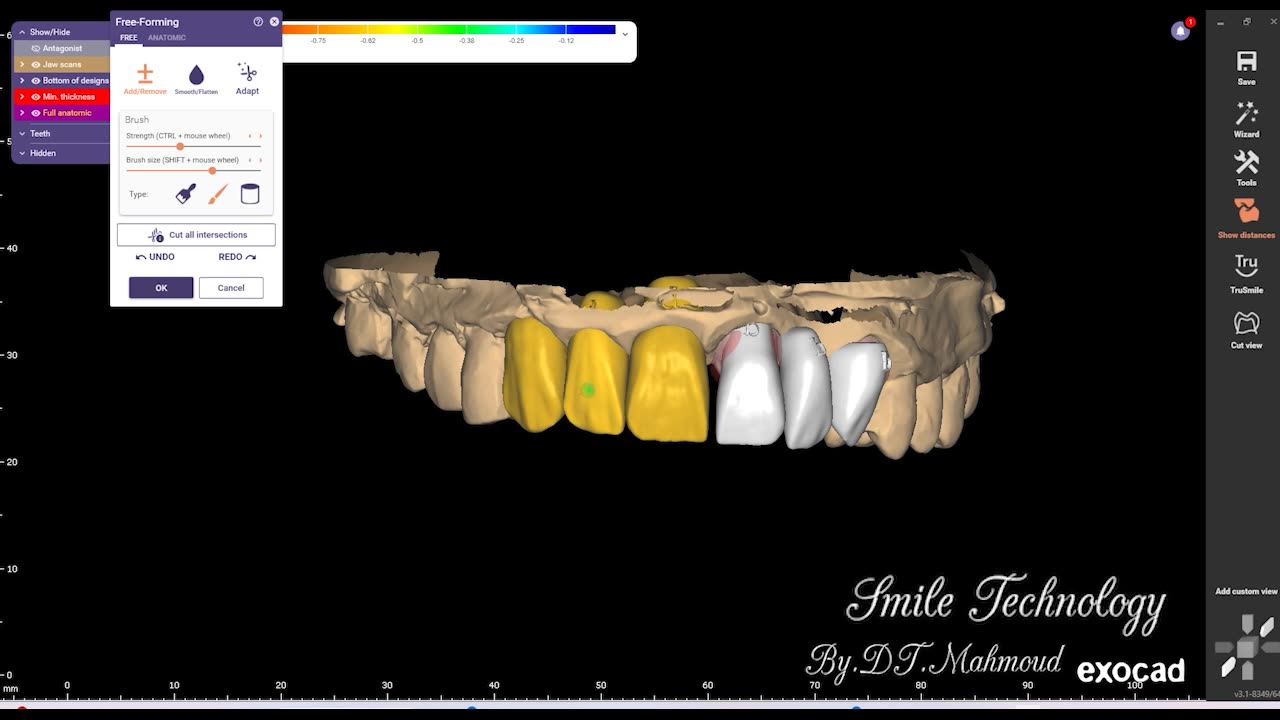 Free form 6 unit anterior teeth Dental design By Exocad