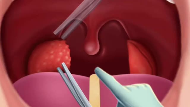 Removal of tonsils |asmr animation |video
