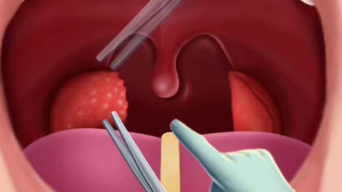 Removal of tonsils |asmr animation |video