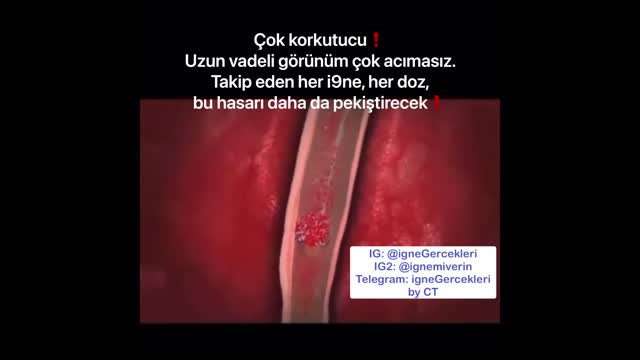 Dr Charles Hoffe kılcal damarlarda oluşan ve biriken ufak kan pıhtılarını anlatıyor