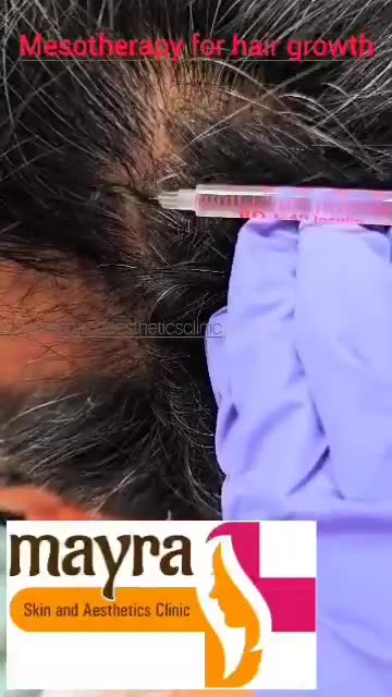Mesotherapy: The Secret to Combat Hair Loss and Boost Growth