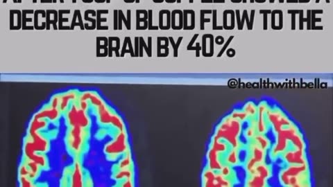 MRI images and blood flow to the brain