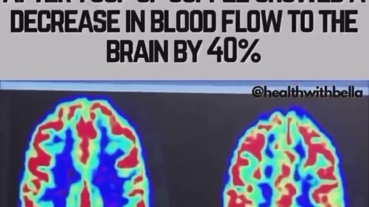 MRI images and blood flow to the brain