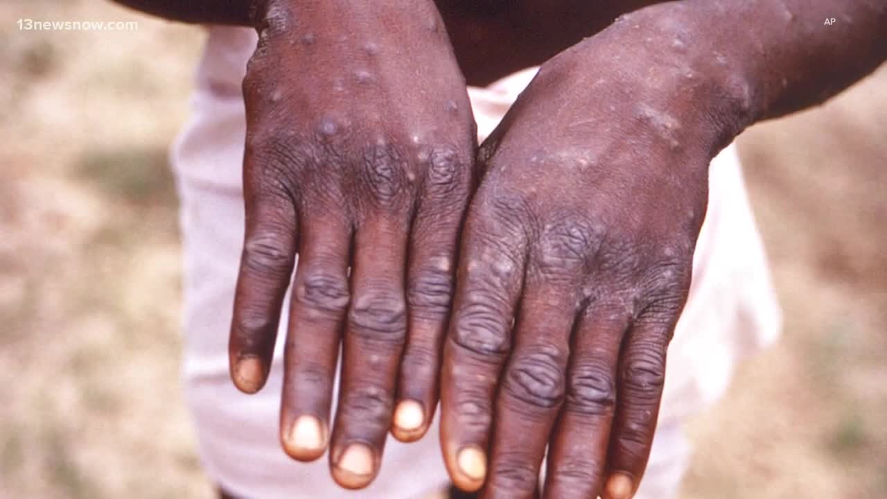 No, Monkeypox has not been declared a pandemic