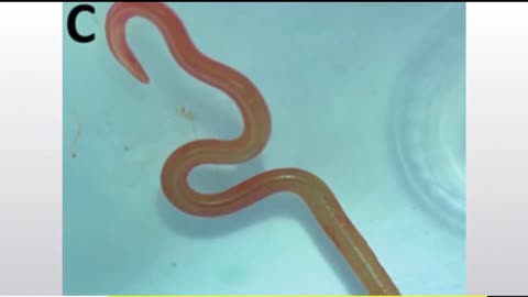 Live worm found in woman's brain in world-first discovery