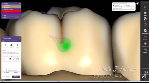 #design #naildesign #dental #dentaldesign #exocadexpert