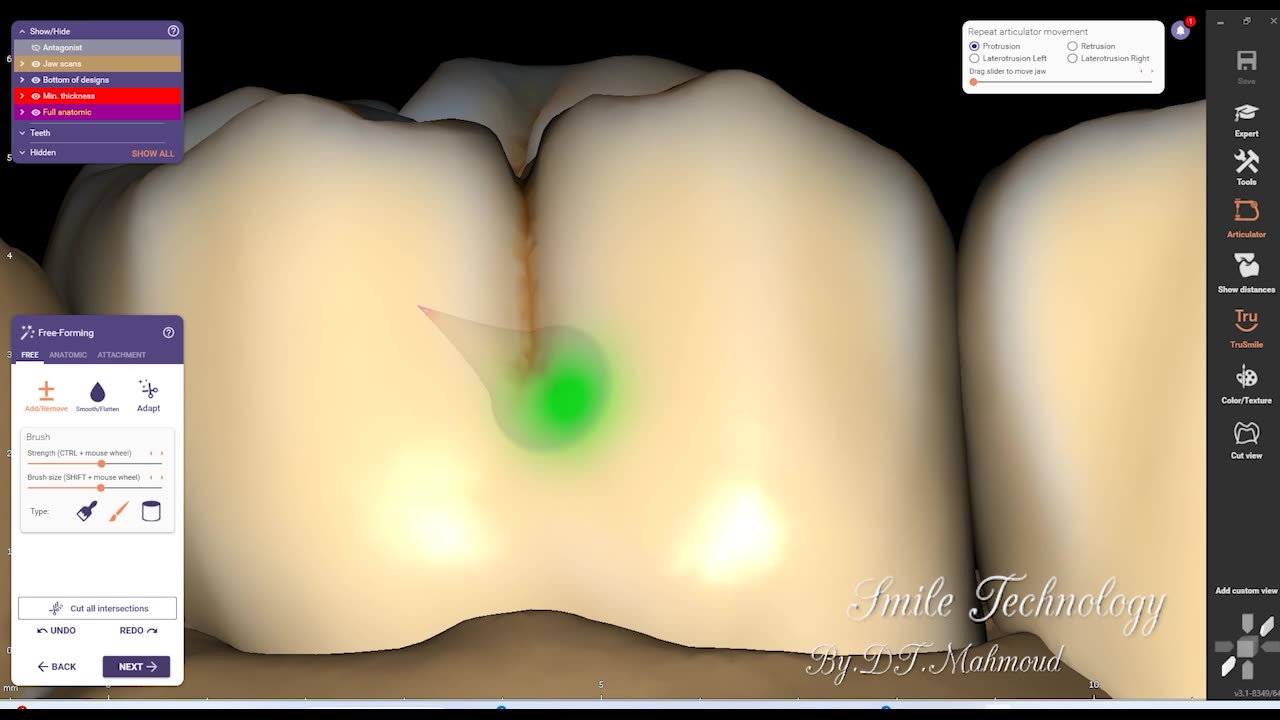 #design #naildesign #dental #dentaldesign #exocadexpert