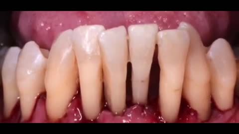 Deep Cleaning of Heavy Tartar on Teeth!!!