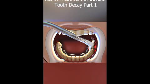 ASMR Treatment of Severe Tooth Decay Part 1