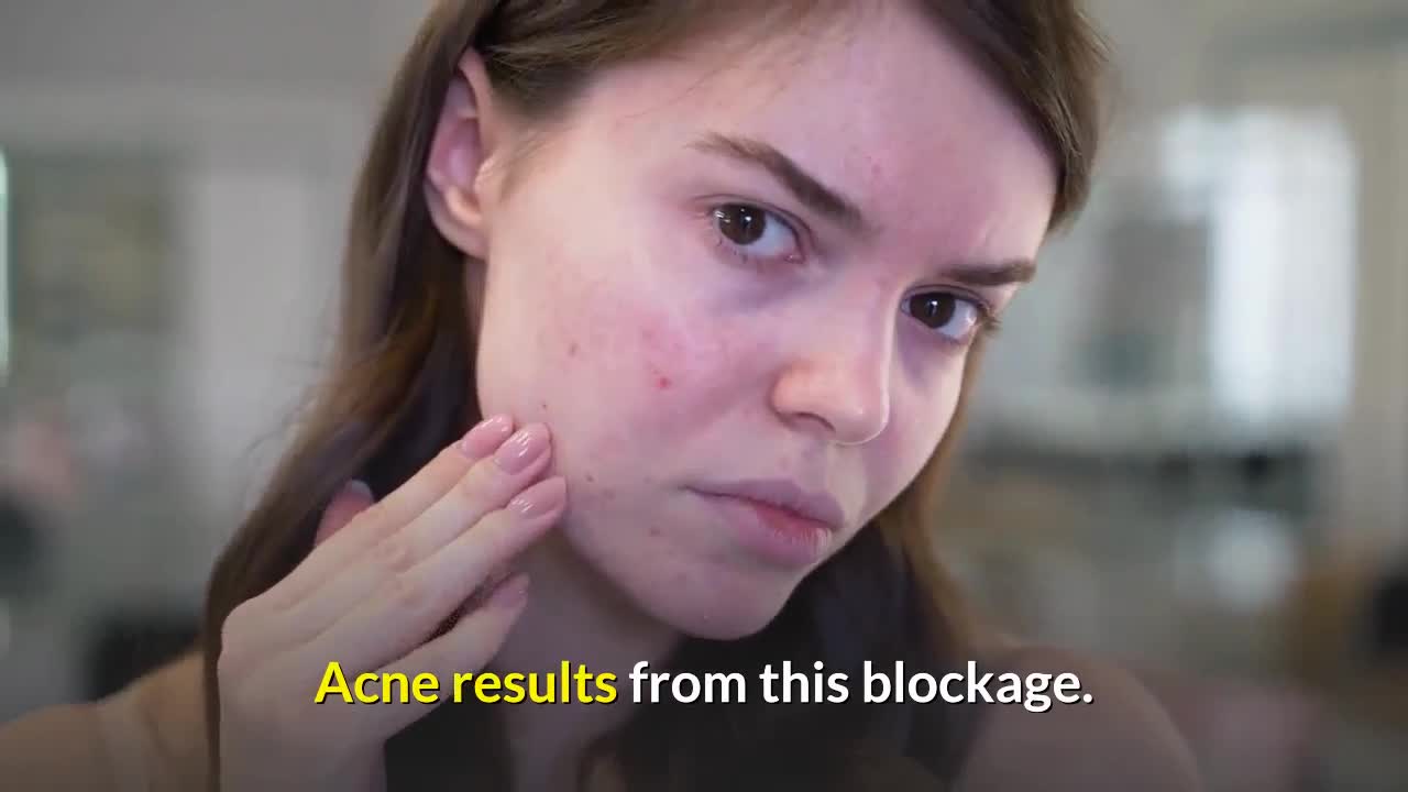 Top 5 Reasons Why You're Having Acne