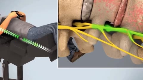Disc herniations, bulging discs or low back pain or neck pain?