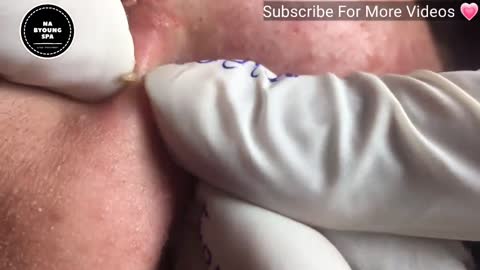 Acne removal from face