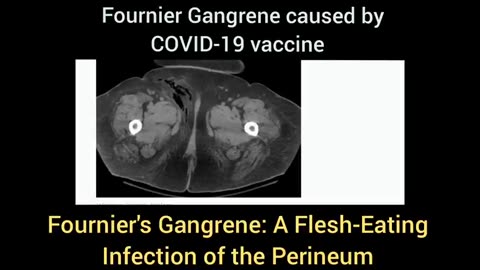 Fournier Gangrene - caused by Covid-19 Vaccine