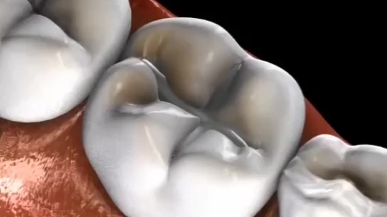 Filling With Occlusal (Amalgam)🦷