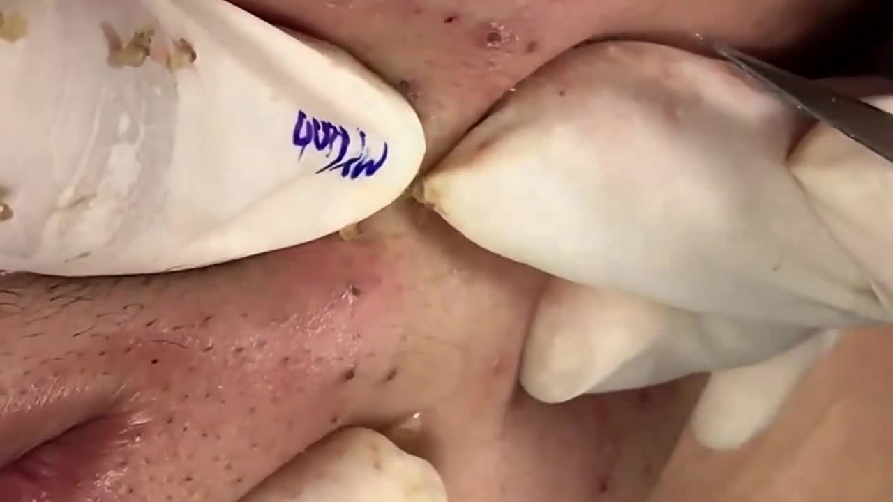 Blackhead Removal Facial and excellent blackhead extraction