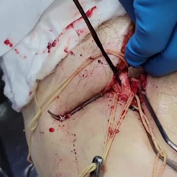 “這。絕對。不正常。”_屍體防腐處理師發佈了“令人難以置信的Blood Clots血凝塊”影片，是在“新冠疫苗實驗針劑（C_19 vaccine）接種受害往生者”身上的“不尋常發現” ～