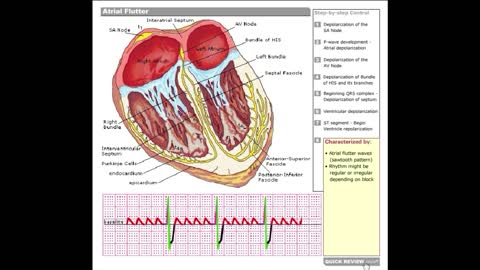 Dr Stanley's ECGcourse.com | Atrial Flutter Tutorial