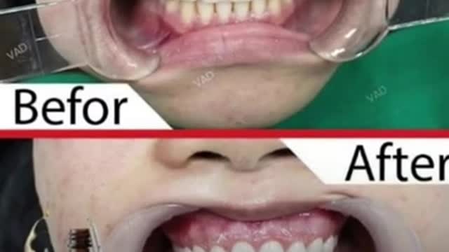 Dentitox pro drops for Toothache & Bad breath