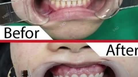 Dentitox pro drops for Toothache & Bad breath