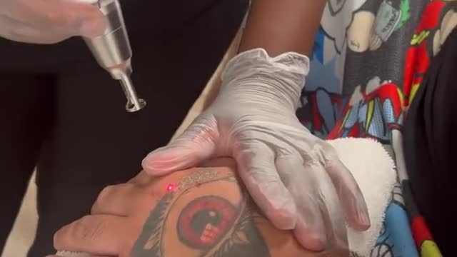 Singer Jimmy Levy Posted A Clip Of Him Getting His "Satanic Tattoo" Removed