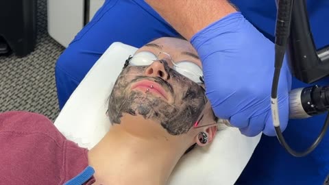 Hollywood Carbon Facial