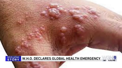 What is mpox?: A new global health emergency