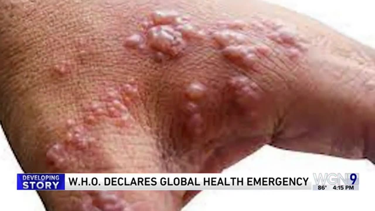 What is mpox?: A new global health emergency