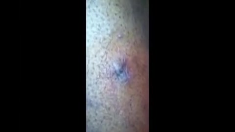 Satisfying Pimple Popping Videos