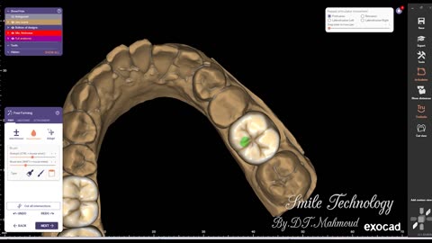 #design #naildesign #dental #dentaldesign #exocadexpert