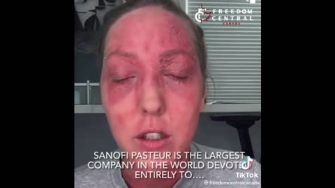 Vaccine-Related Skin Condition