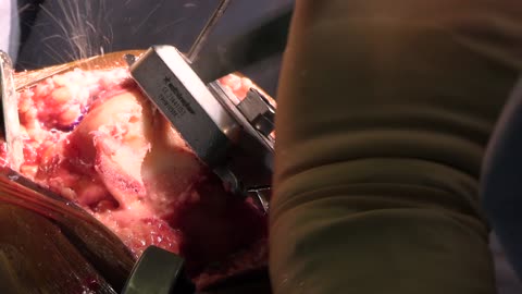 Total knee replacement