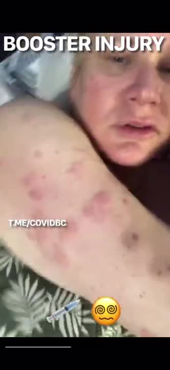 Vaccine Booster injury - "grievous sores" as described by Jesus