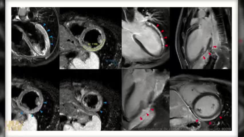 The effect of Covid Jab on children